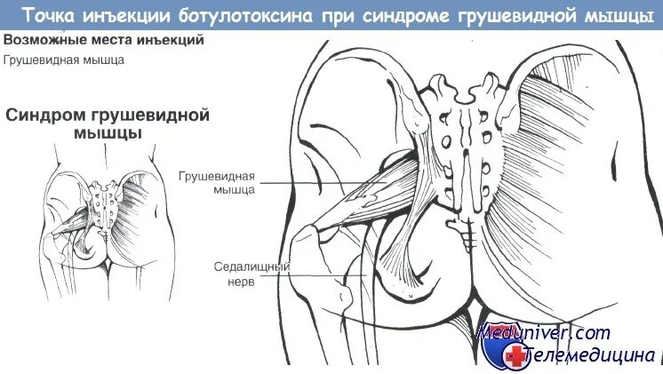 Синдром грушевидной мышцы мкб. Инъекция в грушевидную мышцу. точка грушевидной мышцы. блокада при синдроме грушевидной мышцы. синдром грушевидной мышцы схема.
