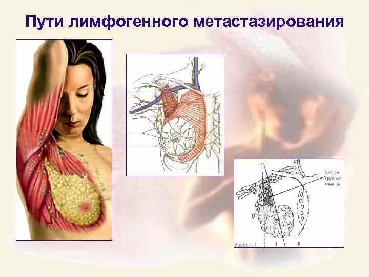 Лимфогенный путь метастазирования. Лимфогенный путь метастазирования опухоли. Лимфогенный путь метастазирования примеры. Метастазирование молочной железы.