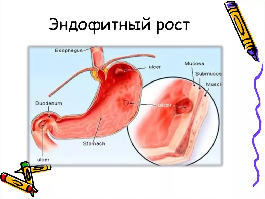 Экзофитный и эндофитный рост опухоли. Экзофитный и эндофитный рост это. Эндофитная форма роста опухоли. Эндофитный рост опухоли