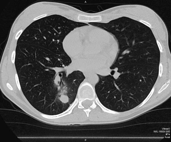 Компьютерная томография грудной полости. Кт грудной клетки и легких. Компьютерная томография грудной клетки.