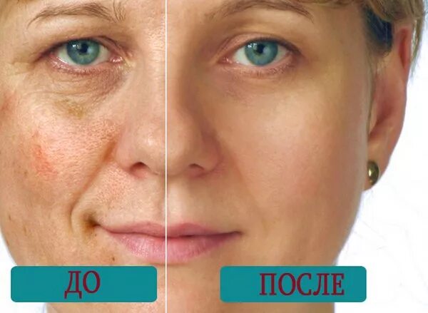 Лазерное удаление пигментных пятен. Лазер от пигментации на лице. лазерная шлифовка пигментация. шлифовка лица от пигментации. лазерная шлифовка лица от пигментных пятен.