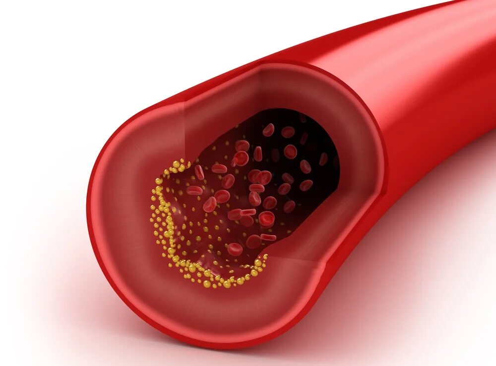 Лишний холестерин. Холестериновые бляшки в сосудах. Внутри кровеносного сосуда. Холестериновые бляшки в сосудах фото. Кровь в кровеносных сосудах.