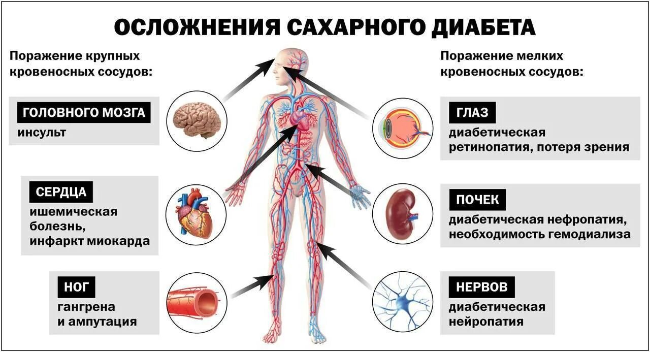 Как заболеть тяжелой болезнью. Осложнения СД 1 типа. Профилактика осложнений сахарного диабета. Хронические осложнения СД. Осложнения СД 1 типа и 2 типа.