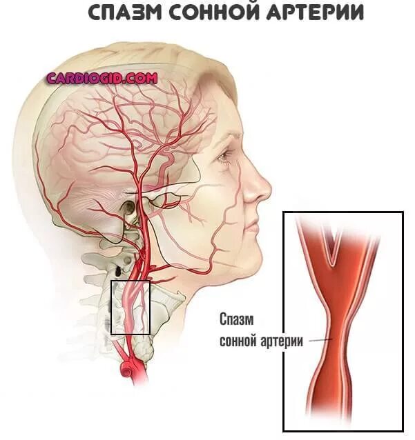 Артерии головного мозга симптомы. Сонная артерия в головном мозге.