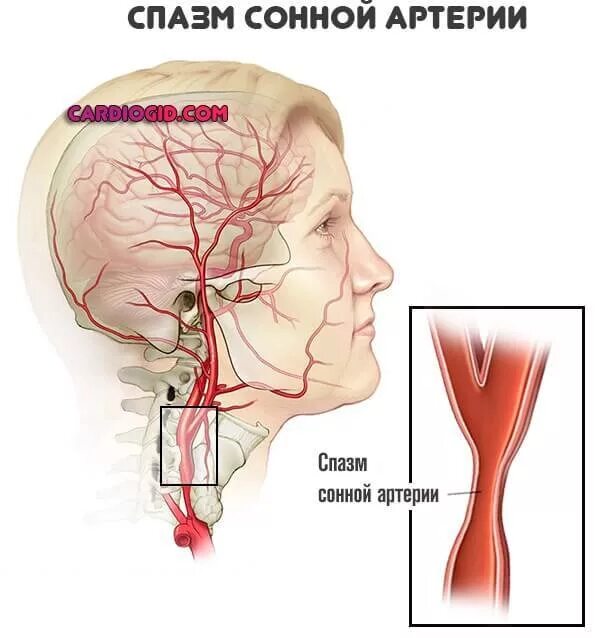 Головная боль сосуды головы. Сонная артерия в головном мозге.
