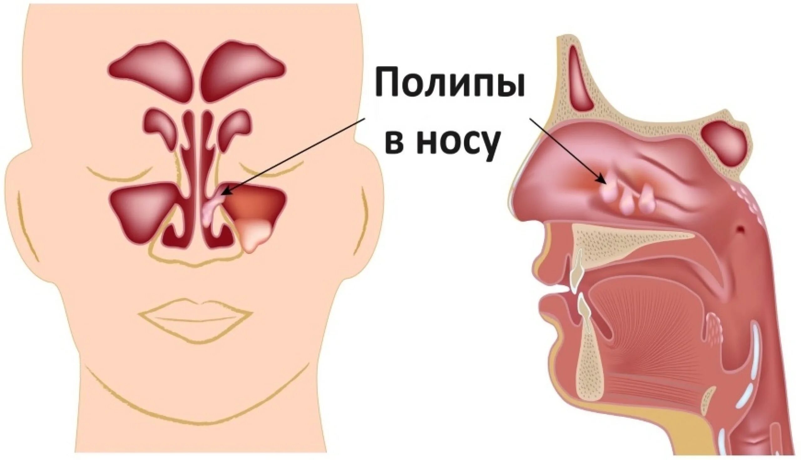 Нос не дышит и течет. Полипозный риносинусит.