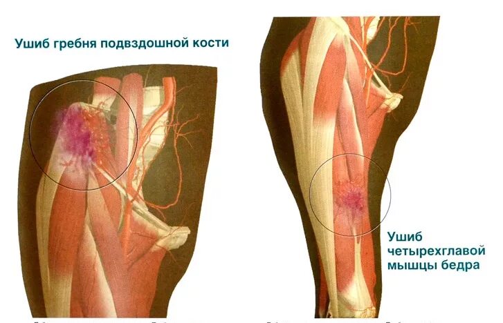 Сильная боль в бедре. Контузия мышцы бедра с гематомой.