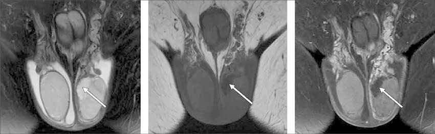 Орхоэпидидимит с абсцессом. Перекрут семенного канатика. Опухли яйца у мужчины причины