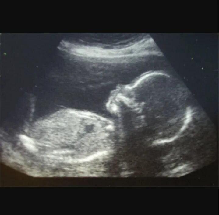 Снимок УЗИ на 21 неделе беременности. УЗИ плода 21 неделя беременности. УЗИ 20-21 неделя беременности. УЗИ ребенка на 21 неделе беременности.