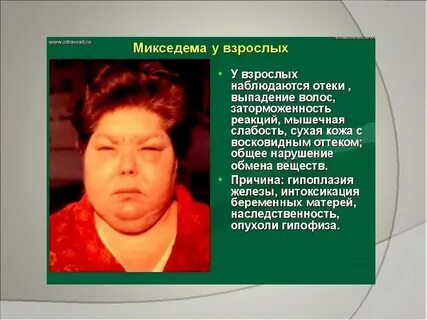 Гормональные отеки у женщин