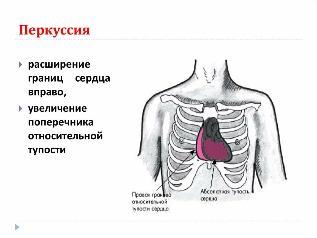 Поперечник относительной тупости сердца в норме. Границы относительной сердечной тупости расширены влево. Перкуссия сердца границы относительной сердечной тупости. Перкуторное расширение границ сердца. Длинник и поперечник