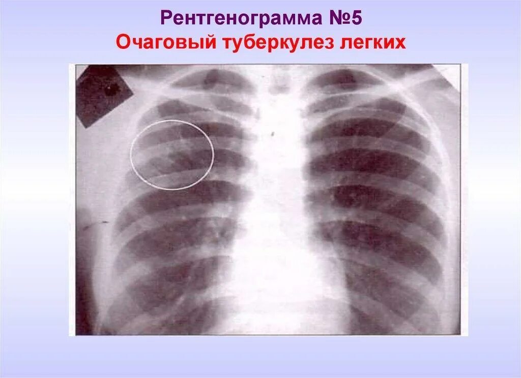 Начальная стадия туберкулеза у взрослых. Очаговый туберкулез рентген. Туберкулёз лёгких у взрослых. Очаговый туберкулёз лёгких.