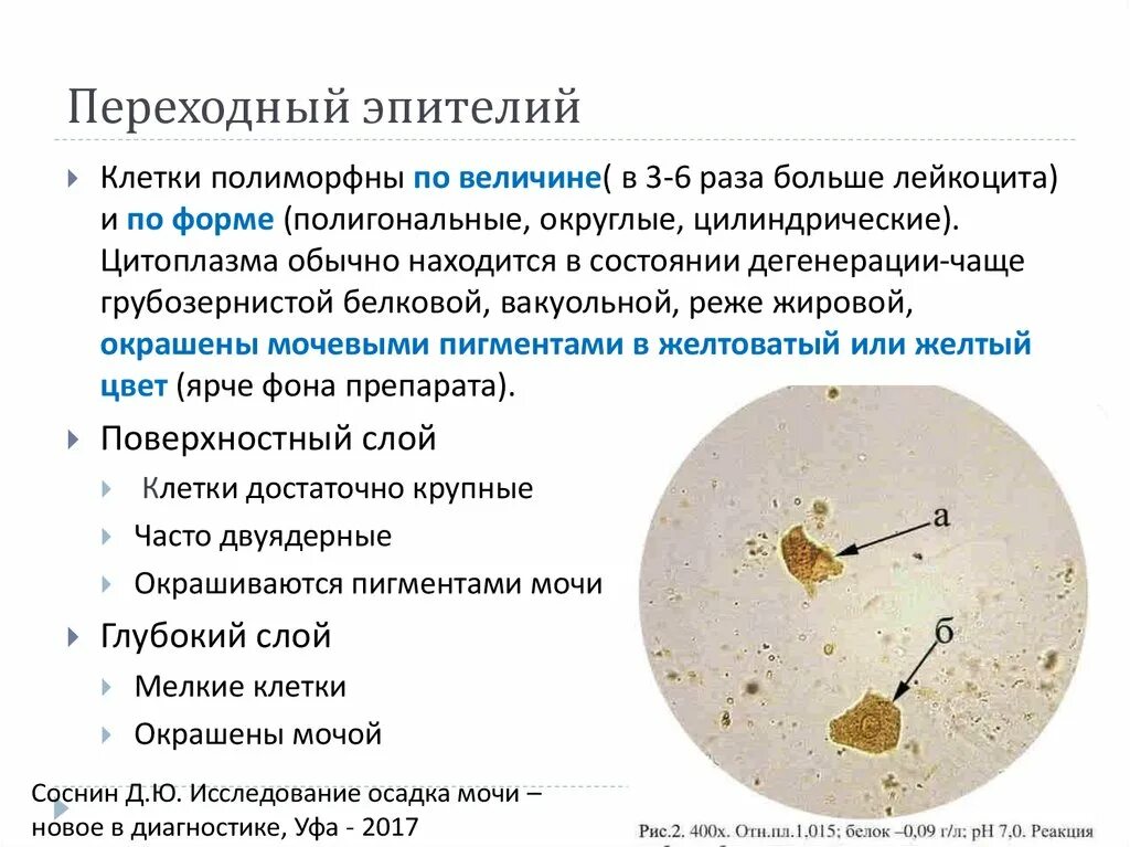 Почему повышается в моче. Эпителий переходной в моче норма. Клетки переходного эпителия в моче. Микроскопия осадка мочи плоский эпителий норма. Переходный эпителий микроскопия мочи.