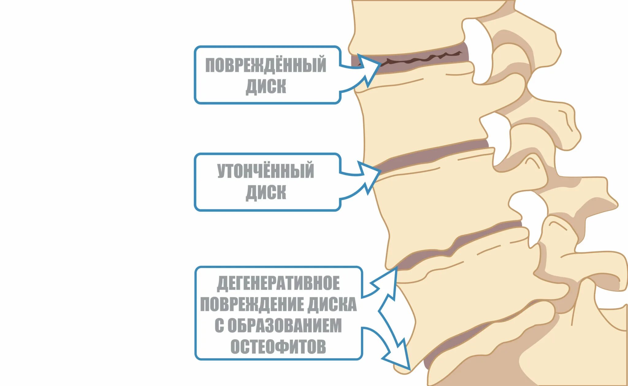 Остеохондроз поясничного отдела позвоночника периоды. Остеохондроз 3 степени поясничного отдела. Остеохондроз 1-2 степени поясничного отдела. Остеохондроз 1 стадии поясничного отдела. Степени развития остеохондроза.