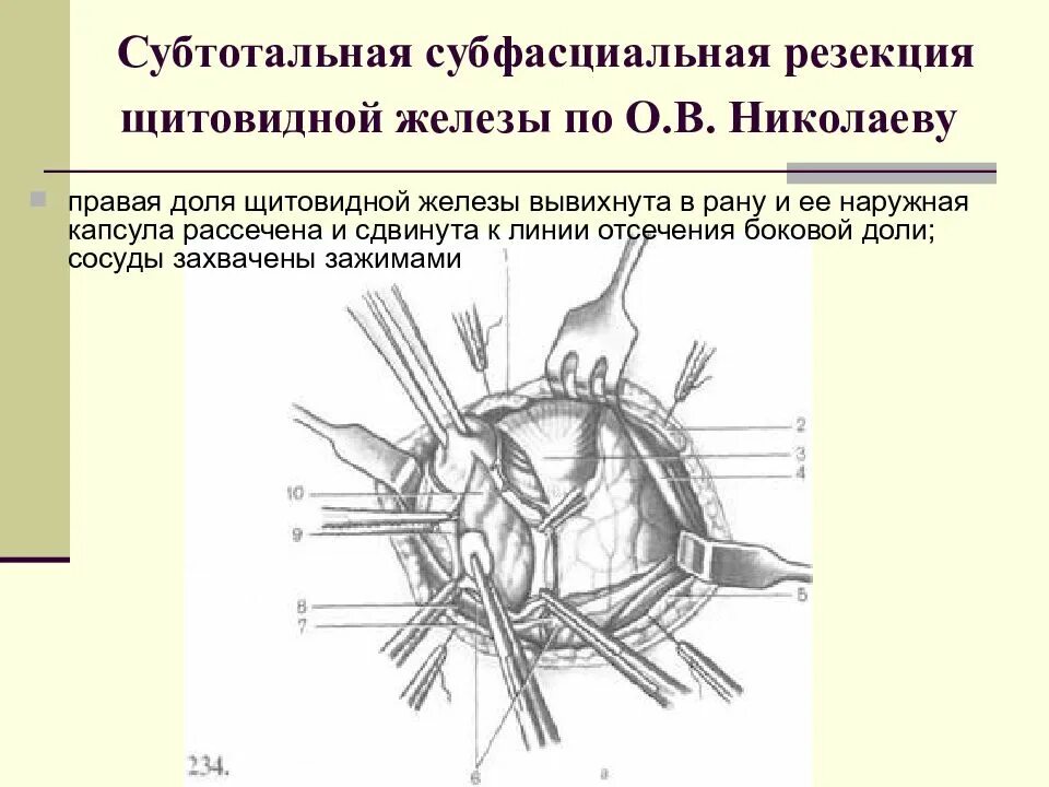 Тиреоидэктомия ход операции. Тотальная тиреоидэктомия щитовидной железы. Энуклеация резекция щитовидной железы. Субтотальная экстрафасциальная резекция щитовидной железы. Щитовидная железа операция стоимость