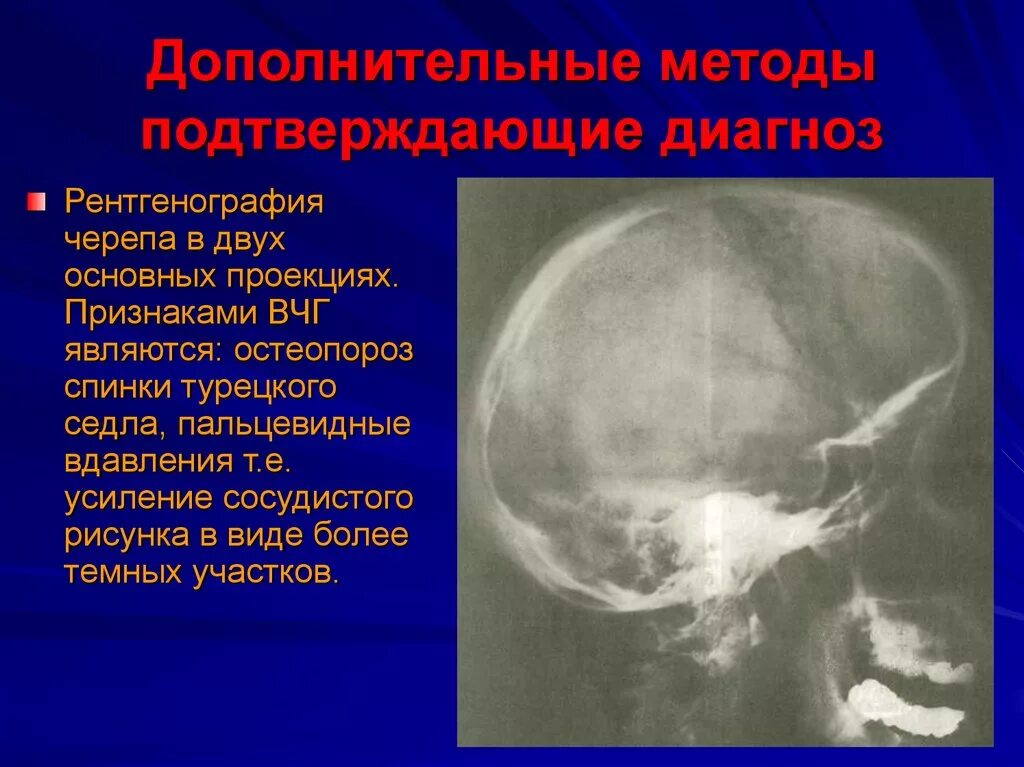 Симптом турецкого седла. Внутричерепная гипертензия на рентгене черепа. Рентгенологические признаки ВЧГ. Рентгенография черепа турецкое седло. Рентген признаки внутричерепной гипертензии.