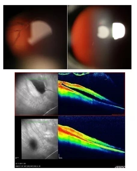 Витреолизис цена. Фотодинамическая терапия сетчатки глаза. Периферическая лазерная коагуляция сетчатки. Лазерное укрепление сетчатки. Запаивание сетчатки лазером.