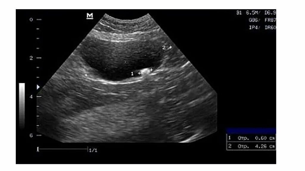 Акустические тени в почках. Полип желчного пузыря на УЗИ. Камни в мочевом пузыре УЗИ. Гиперэхогенное образование в мочевом пузыре. УЗИ почек и мочевого пузыря.