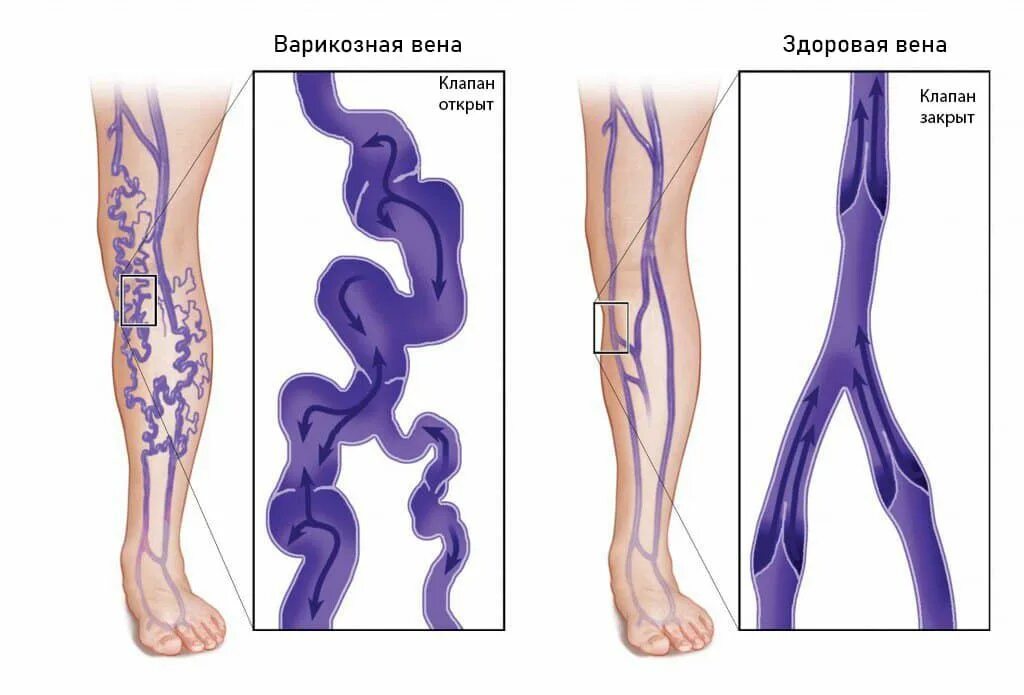 Варикозное расширение вен (ВРВ) нижних конечностей. Варикозное расширение вен нижних конечностей анатомия. Варикозное расширение вен нижних конечностей этиология и патогенез. Варикозная болезнь вен нижних конечностей стадии. Что значит расширение вен