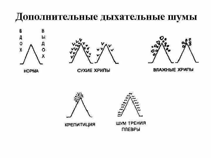 Дополнительные дыхательные шумы схема. Побочные дыхательные шумы схема. Механизм возникновения основных дыхательных шумов. Везикулярное дыхание и бронхиальное дыхание. Жесткое везикулярное дыхание