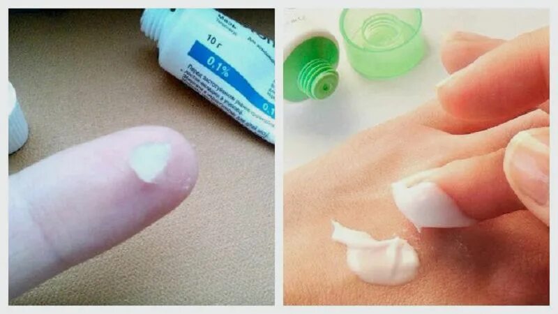 Как выглядит аллергия на ногти