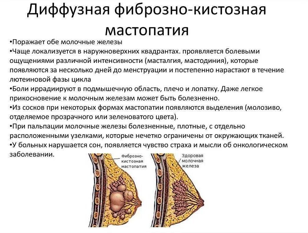 Диффузное уплотнение молочной железы. Фиброзно-кистозная мастопатия молочной железы. фиброзно кистозная мастопатия груди. фиброзно-кистозная мастопатия диффузной формы молочных желез. фиброзно-кистозная мастопатия симпто.