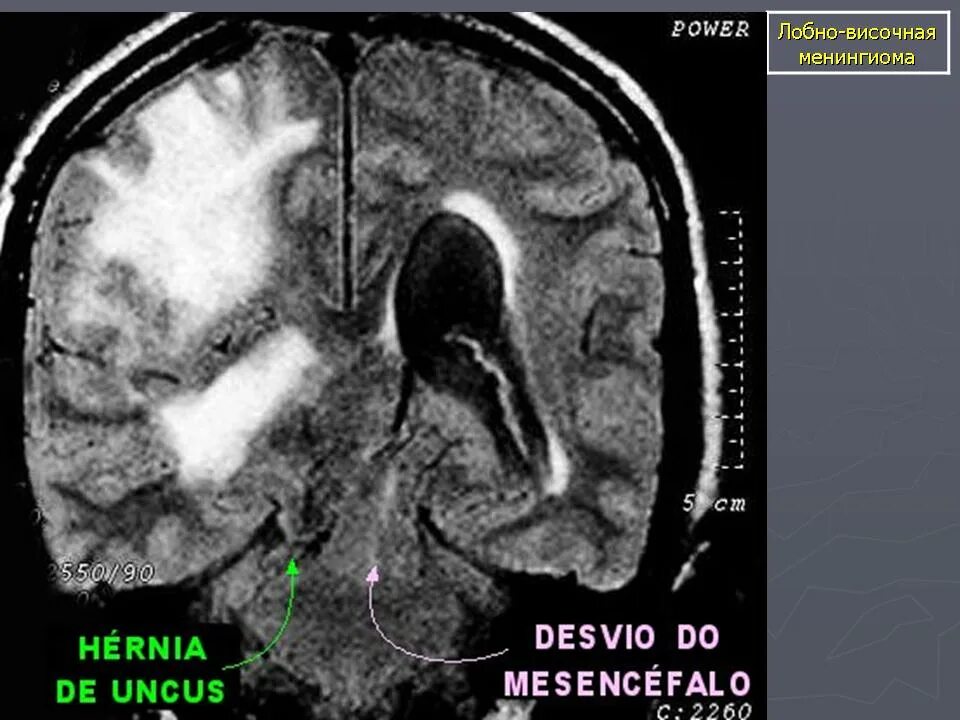 Образование в лобной доле. Менингиома в правой лобной области. Менингиомы головного мозга на кт. Менингиома лобной доли мрт. Менингиома височной области мрт.