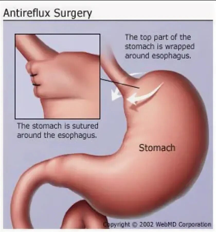 Кардия не смыкается что это значит. Plastic Surgery of the esophagus for Burn strictures.