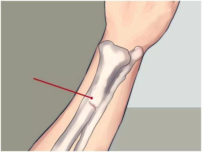 Поднадкостничные переломы. Перелом голени лучевой кости. Перелом надкостницы лучевой кости. Надкостница перелом надкостницы. Как понять что у тебя трещина