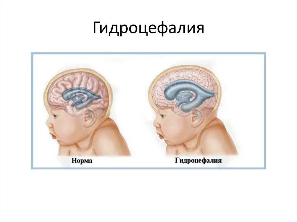 Признаки гидроцефалии мозга