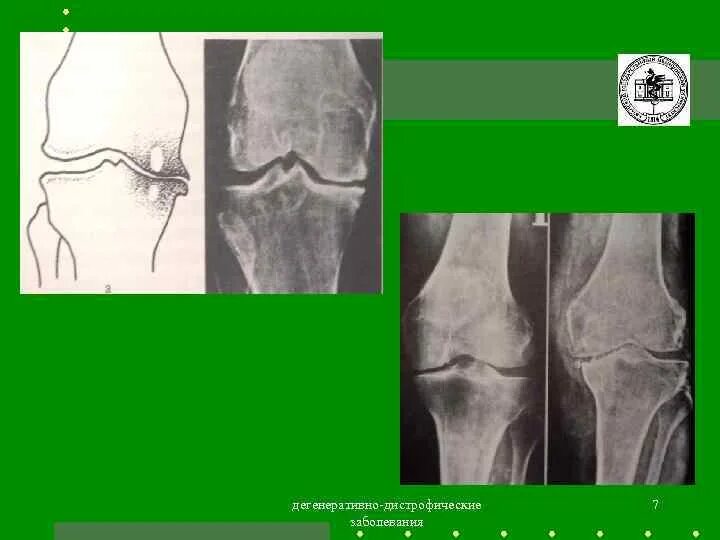Дегенеративно дистрофические поражения. Дегенеративно-дистрофические изменения в суставе. Дегенеративно-дистрофические заболевания суставов. Дегенеративные поражения суставов. Дистрофические изменения суставов.