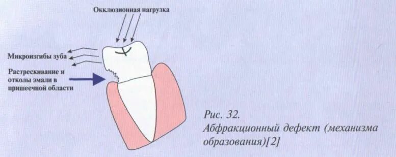 Пломбирование кариозных полостей 5 класса. Пломбирование полостей по блэку. пломбирование 5 класса по блэку. пломбирование 1 класса по блэку. пломбирование полостей 5 класса по блэку.