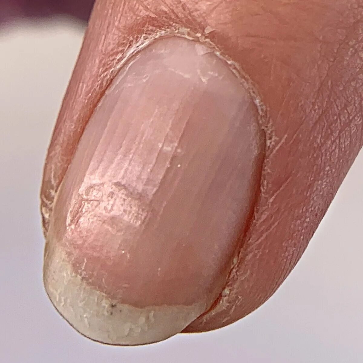Пропилы ногтевой пластины