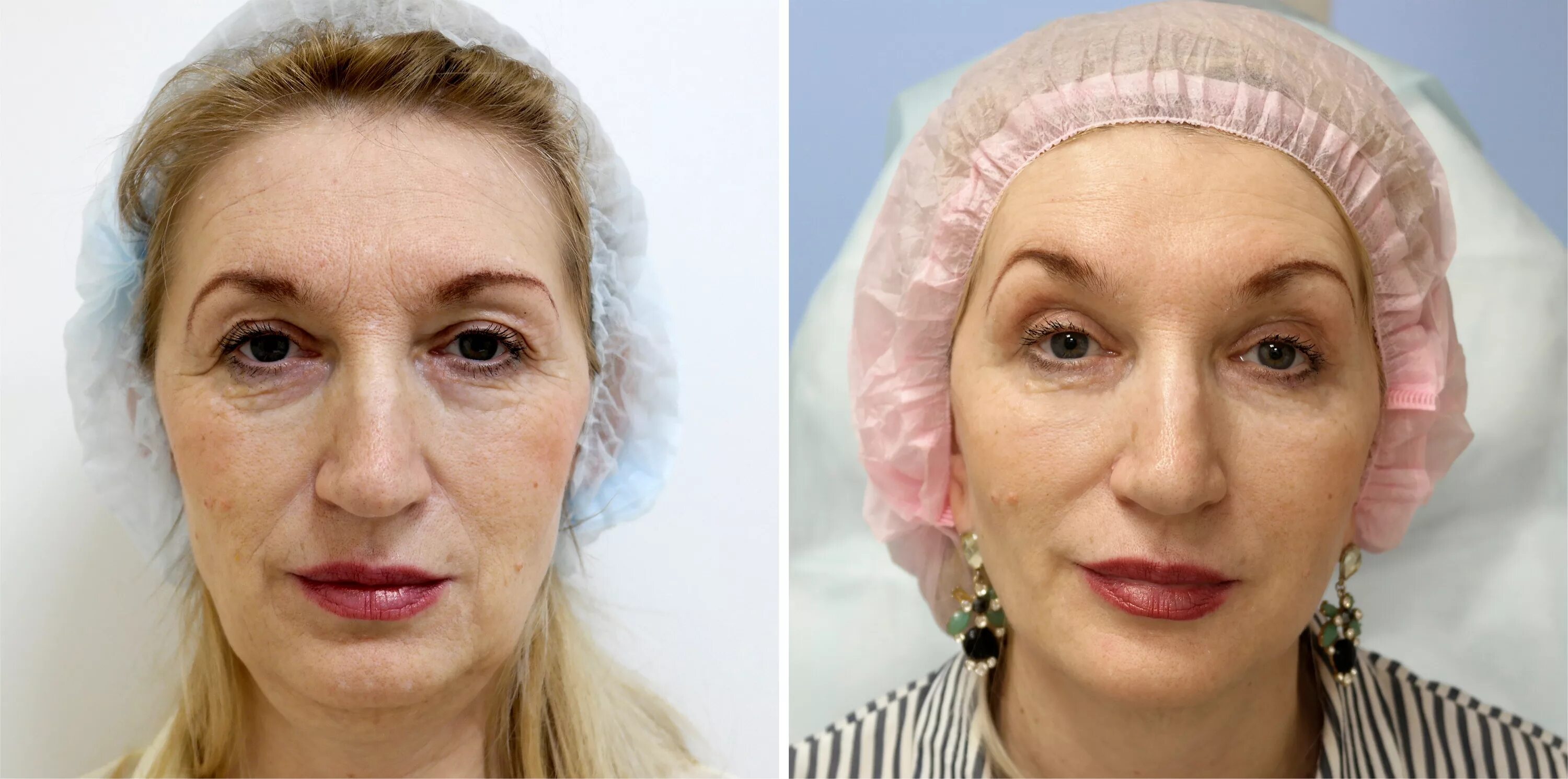 Комплексная процедура омоложения контурной пластикой: FULL FACE