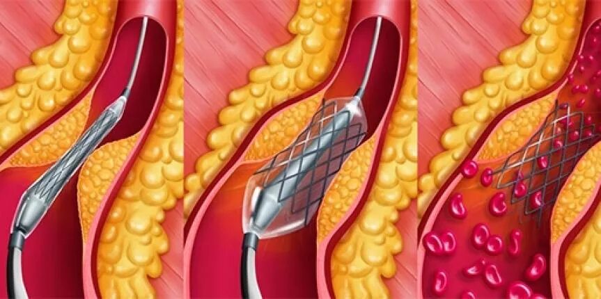 Стент после операции. Атеросклероз сосудов сердца стентирование. Атеросклероз сосудов стент. Стентирование сосудо сердце. Аортокоронарное стентирование сосудов.