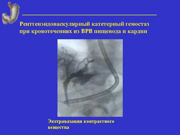 Что такое экстравазация. Экстравазация контраста. экстравазация контрастного вещества.