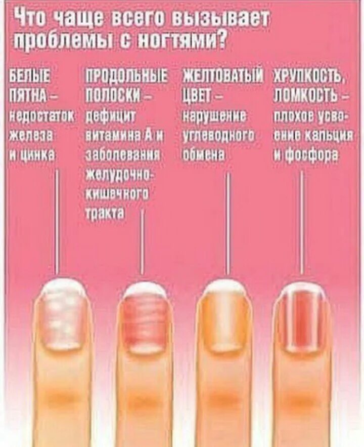 Что означают белые пятна на ногтях рук. Белые полоски на ногтях нехватка витамина. Ногти заболевание по ногтям на руках. Белые пятна на ногтях дефицит витамина.