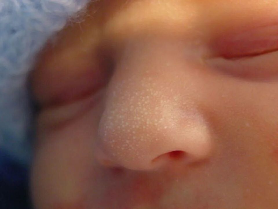 Милиум Просянка у новорожденных. Маленькие пупырышки на носу у ребенка что это.