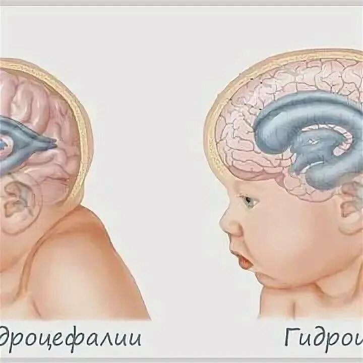 Смешанный гидроцефалия у взрослых. Декомпенсированная гидроцефалия. внутренняя водянка головного мозга. смешанная гидроцефалия. внутренняя гидроцефалия.
