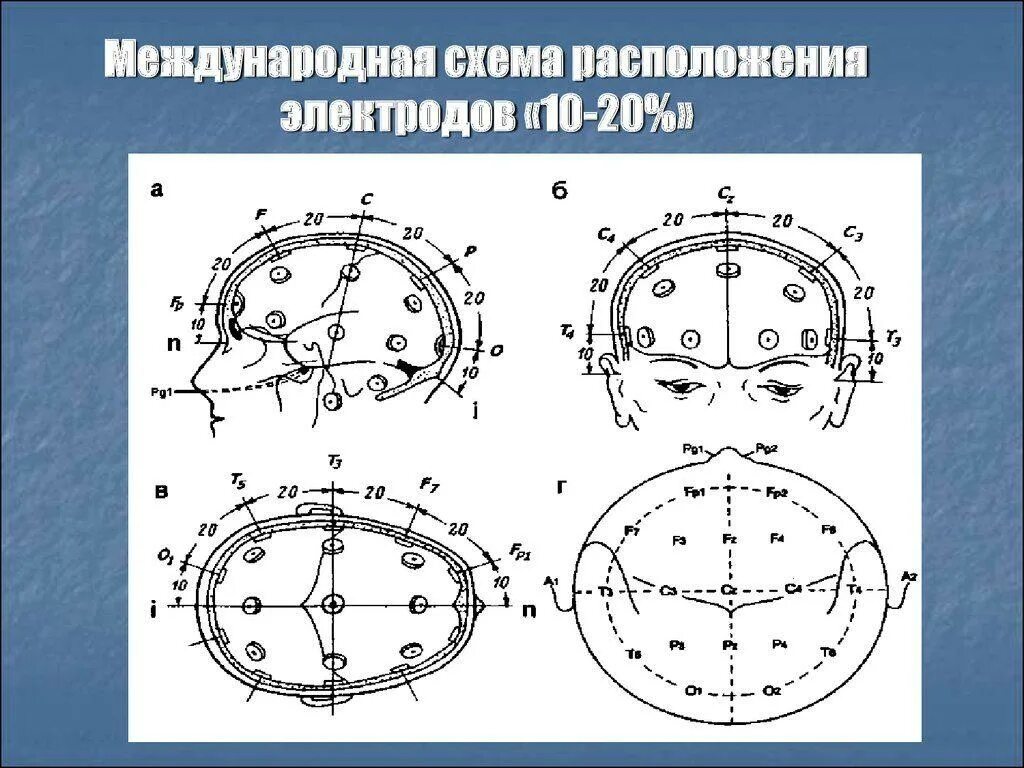 Схема расположения электродов 10-20 ЭЭГ. ЭЭГ наложение электродов схема 10-20. Схема наложения электродов при ЭЭГ 10-20. ЭЭГ головного мозга схема расположения электродов.