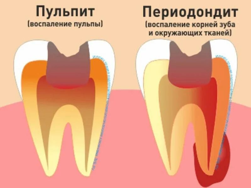 Как отличить зубную боль от воспаления. Пульпит периодонтит зубов. Периодонтит и пульпит разница. Классификация кариес пульпит периодонтит. Пульпит зуба классификация.