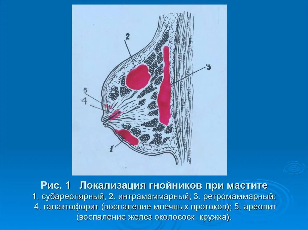 Гнойный послеродовый мастит. Мастит серозный инфильтративный Гнойный. Субареолярный Гнойный мастит. Интрамаммарный Гнойный мастит.