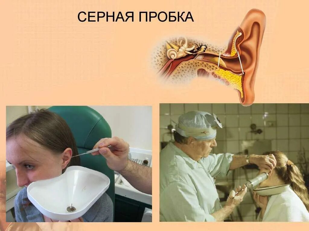 Пробку из уха самостоятельно