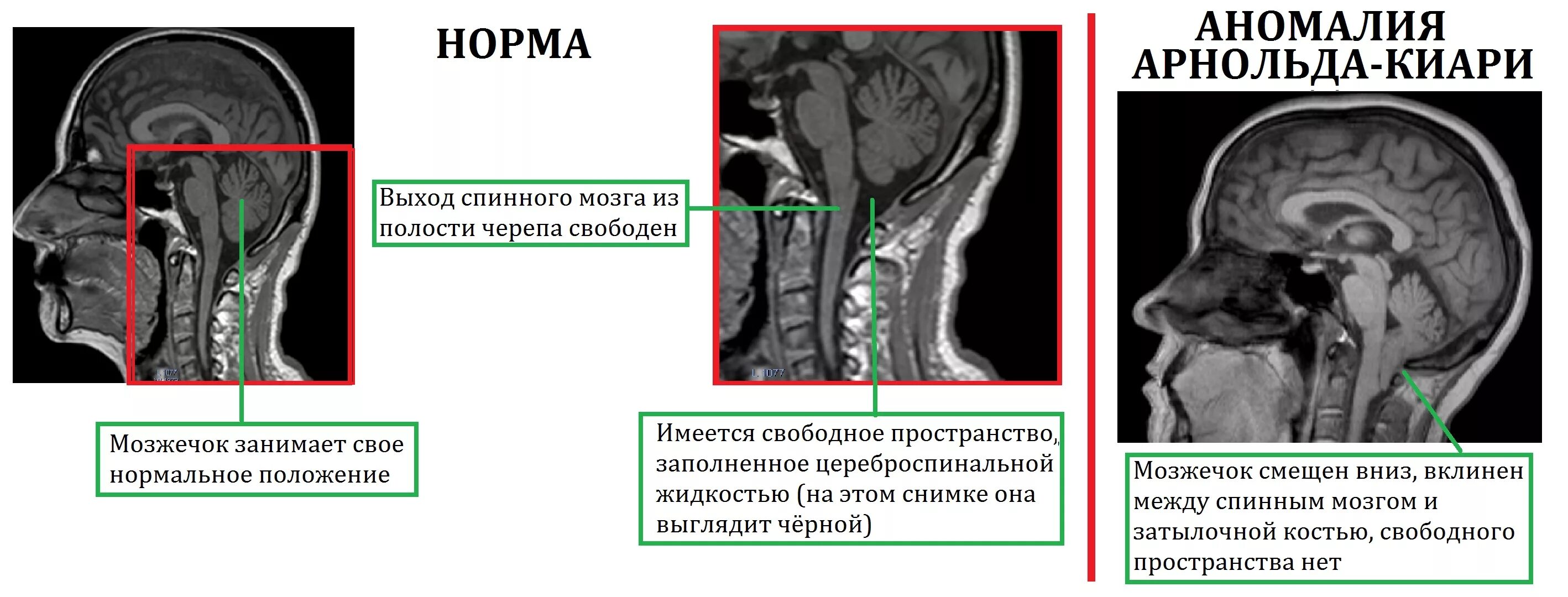 Мозжечок у плода норма. Аномалия Арнольда Киари 1 мрт. Аномалия Киари 1 типа на мрт. Картина аномалии Арнольда Киари 1 типа. Аномалия Киари 2 типа мрт.