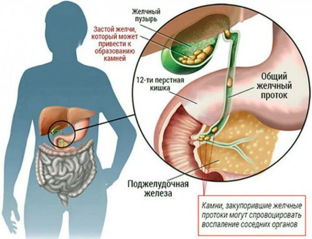 Желчекаменная болезнь холецистит.