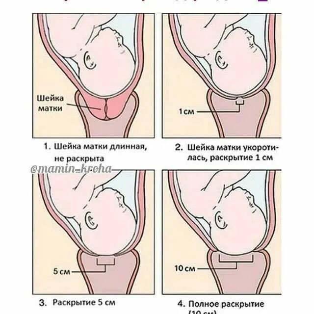 Почему укорачивается матка. Раскрытие шейки матки при родах.