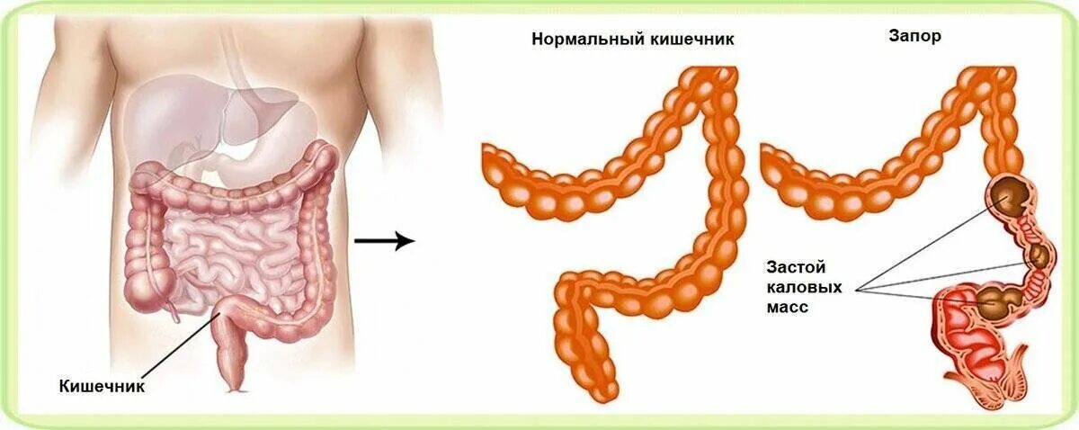 Запор больно. Спастический запор. Каловые массы в кишечнике.