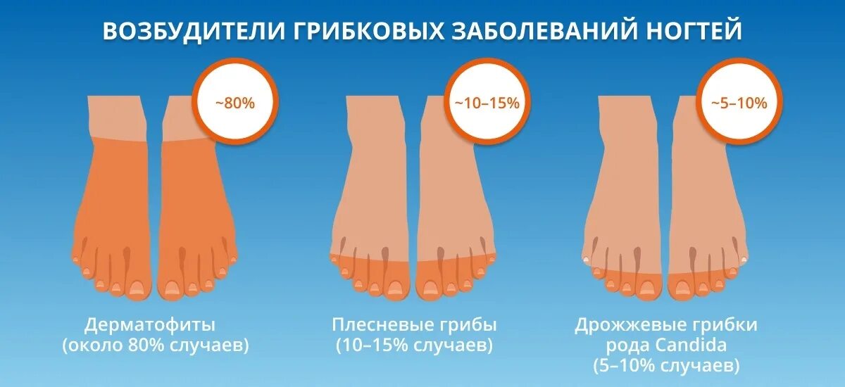Соберите информацию о грибковых заболеваниях. Типы грибковых инфекций ногтей. Типы грибков на ногтях ног. Разновидности грибка ногтей на ногах.