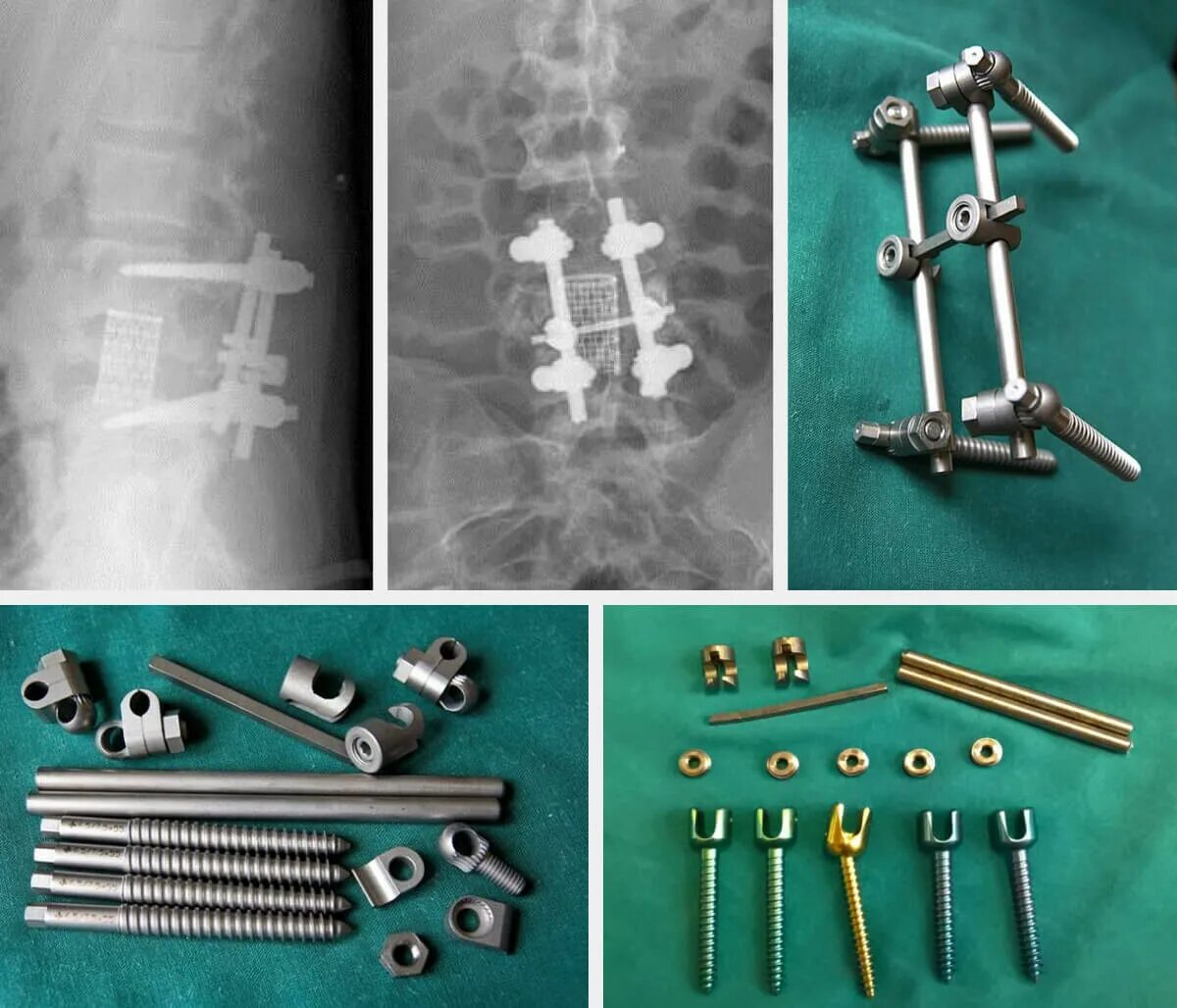 Реабилитация после операции на позвоночнике с металлоконструкций. Кейдж передний спондилодез. Вентральный спондилодез. Транспедикулярный остеосинтез позвоночника. Межтеловой Кейдж Stryker OIC 11mm 4 град.