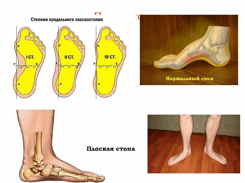 Изменения свода стопы. Продольное плоскостопие 2б. продольное плоскостопие 2. продольный свод стопы плоскостопие. продольное плоскостопие 3 степени.